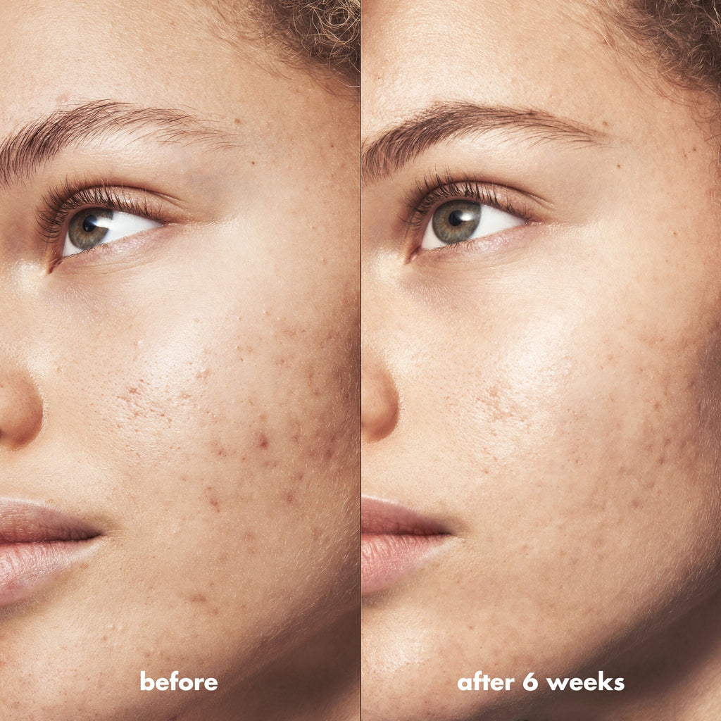 Blemish Breakthrough Blemish Control Basics Kit